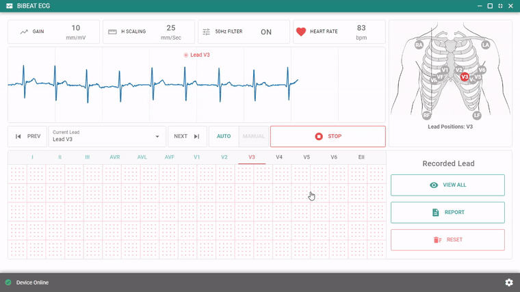 BiBEAT ECG app in auto mode, stepping from lead V3 to V4 while the live trace and heart rate update